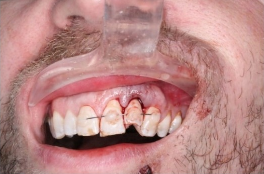 Dental trauma management - Pre-operative photo and X-ray case 2